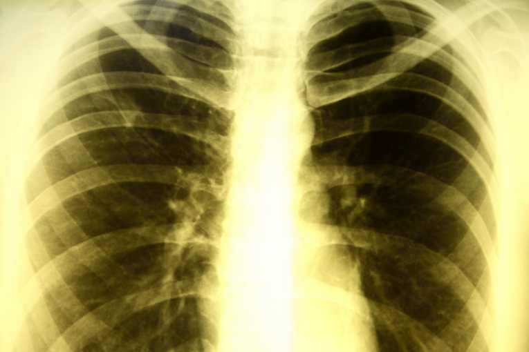 Smoking linked to rising tuberculosis deaths worldwide