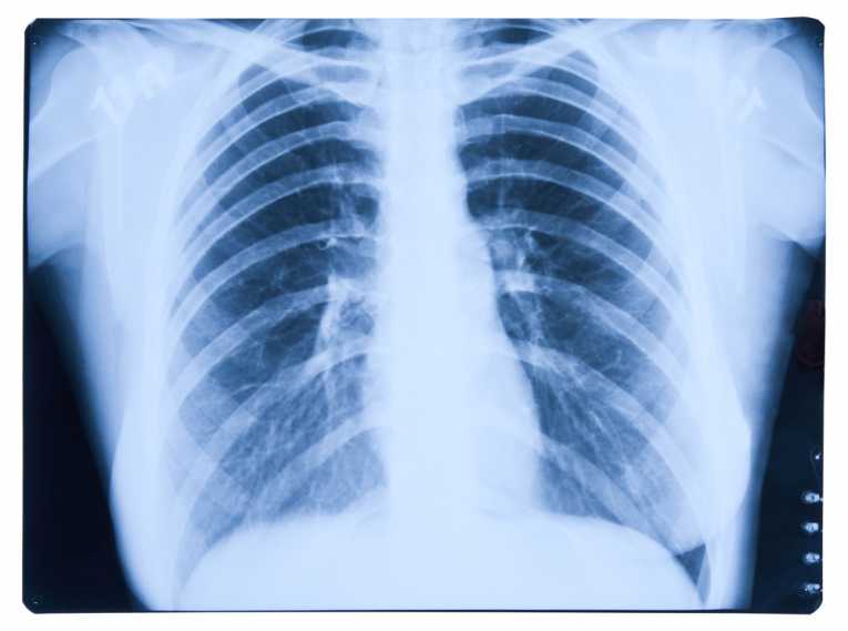 Early Detection of COPD could help prevent lung cancer