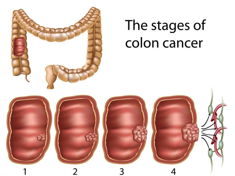 New initiative for early diagnosis of genetic colorectal cancer