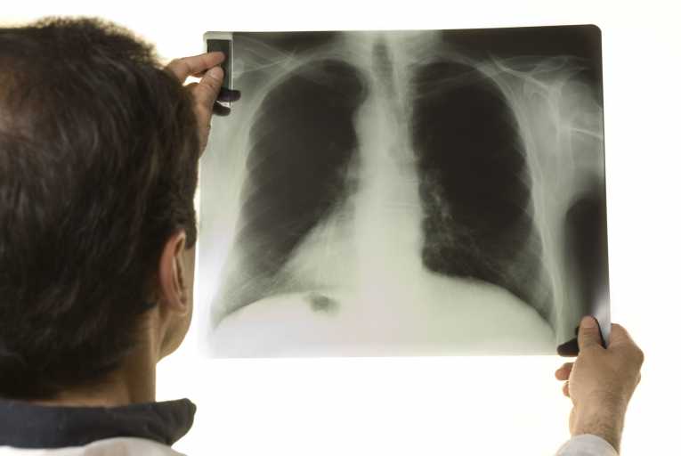 A new, more effective vaccine to combat TB could soon be created