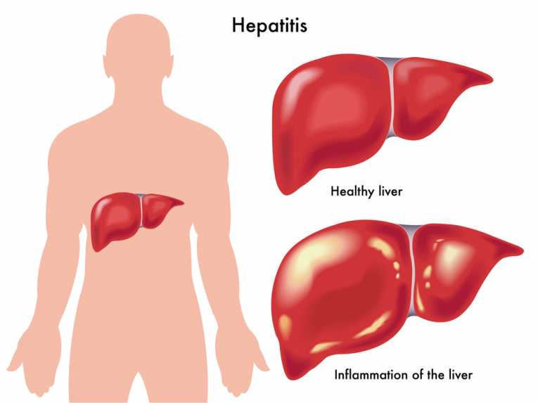 World Hepatitis Day - 28th July